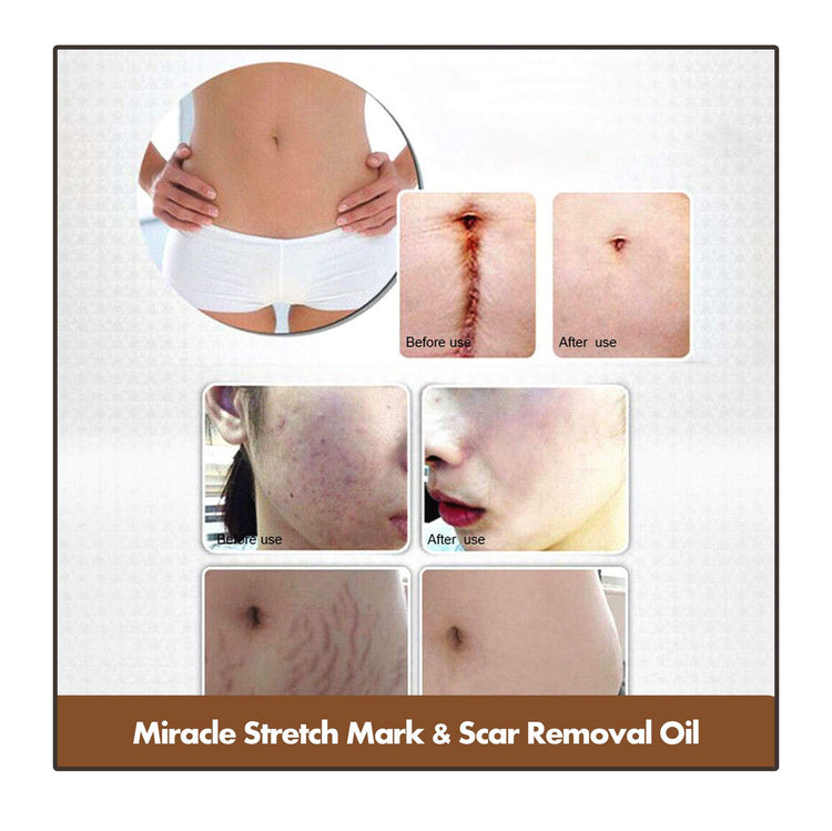 Miracle Stretch Mark & Scar Removal Oil