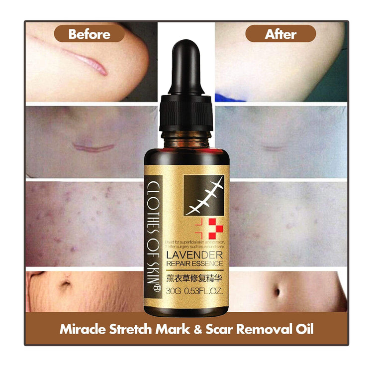 Miracle Stretch Mark & Scar Removal Oil