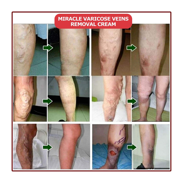 Miracle Varicose Veins Removal Cream