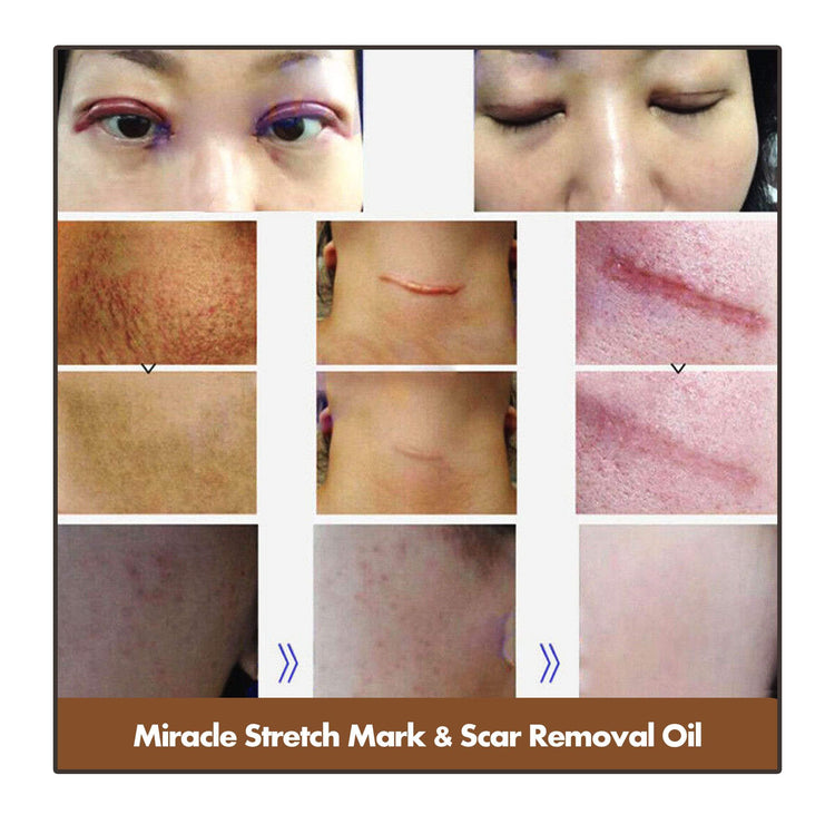 Miracle Stretch Mark & Scar Removal Oil