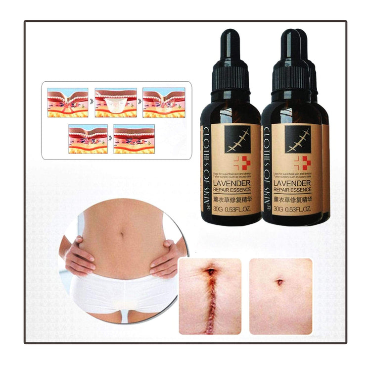 Miracle Stretch Mark & Scar Removal Oil