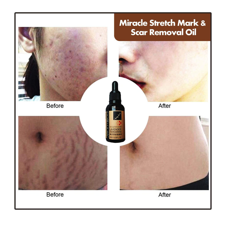 Miracle Stretch Mark & Scar Removal Oil