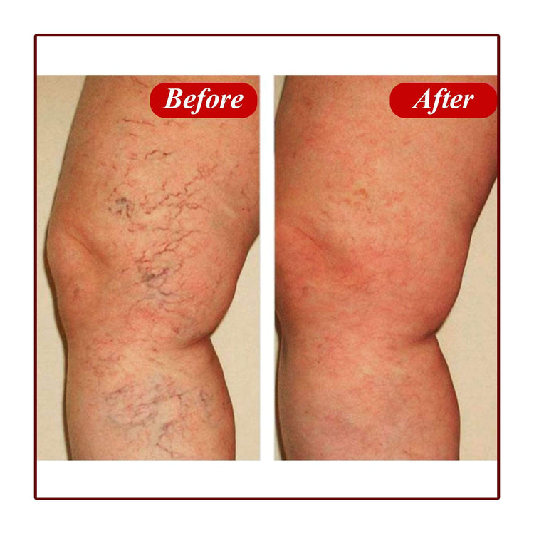 Miracle Varicose Veins Removal Cream