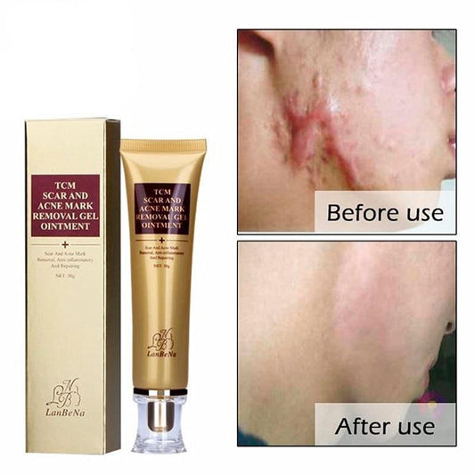 Miracle Acne Scar Cream