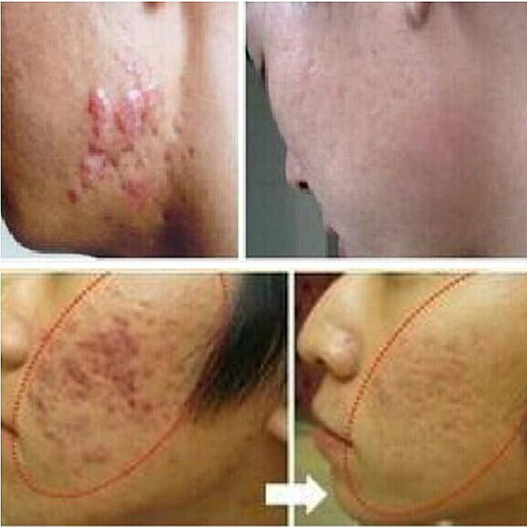 Miracle Acne Scar Cream