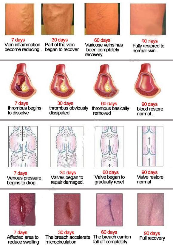 Miracle Varicose Veins Ointment