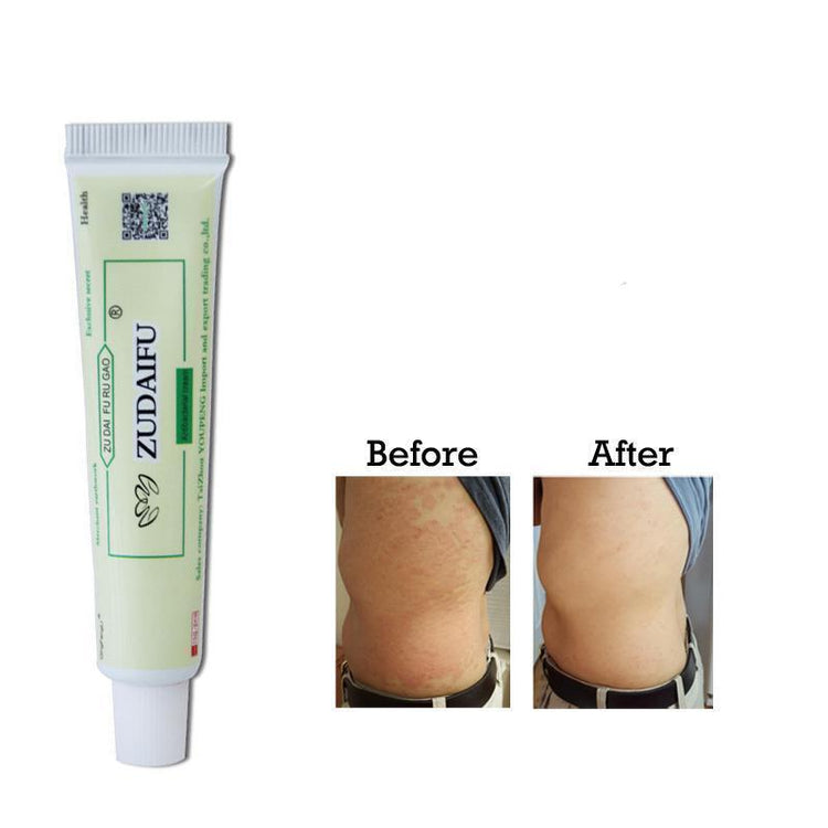 Natural Psoriasis Removal Cream