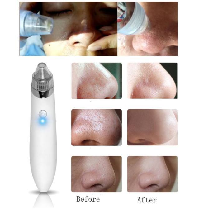 Vacuum Pore Cleanser